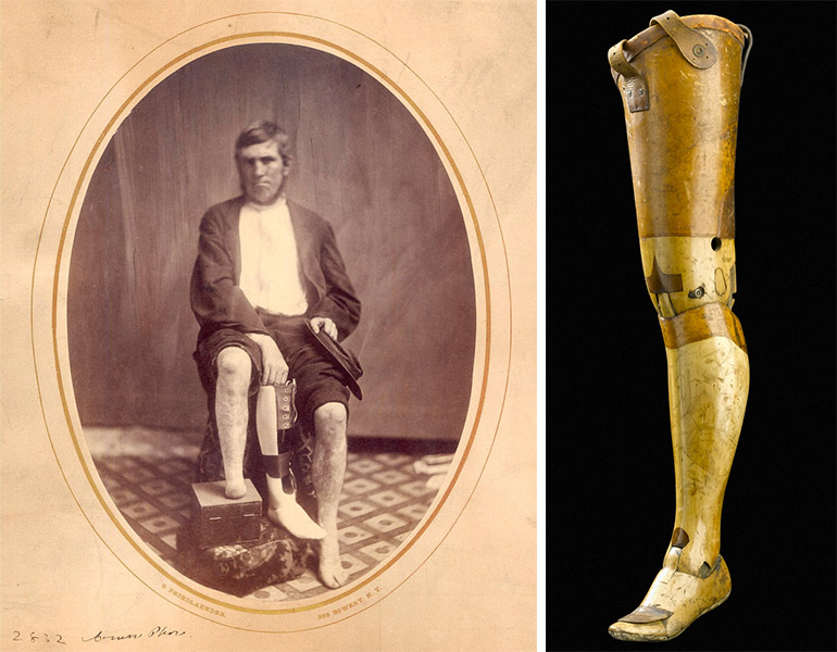 История протезирования: от древности до наших дней